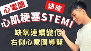 【8分鐘搞定心肌梗塞心電圖】STEMI ECG實際案例導覽！心肌梗塞臨床症狀、右側心電圖判讀、ACLS、前壁梗塞、側壁梗塞！醫學生臨床值班必備技能！心肌缺氧連續性心電圖變化、十二導程心電圖、課後測驗！