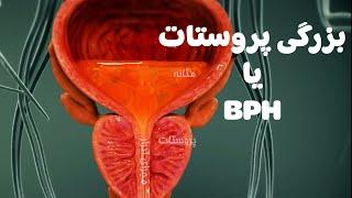 بزرگی خوش خیم پروستات یا بی پی اچ یک بیماری شایع است BPH