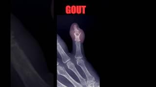 Gout #radiology #doctor #arthritis