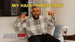 My Hair Transplant in Turkey | $3,500 Transformation