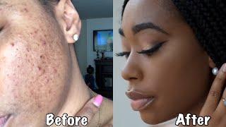 HOW I PREVENT HYPERPIGMENTATION WHILE WEARING MAKEUP|ChimereNicole