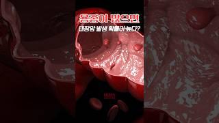용종이 많으면 대장암 발생 확률이 높을까? [암팩트]