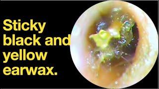 Sticky black and yellow earwax. |ear wax removal | ear cleaning | ASMR | relaxation | relax