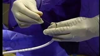 Endoscopía | Video instructivo de PEGJ