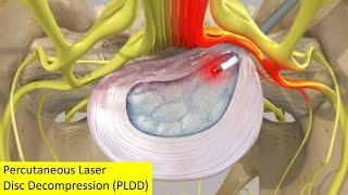 Percutaneous laser disc decompression (PLDD)