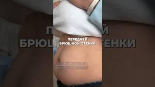 Как избавиться от грыжи? #массаж #лечение #остеопат #доктор #здоровье
