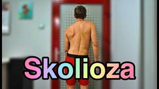 Skolioza. Scoliosis. Ćwiczenie korekcyjne