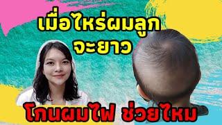 เมื่อไหร่ผมลูกจะยาว โกนผมไฟช่วยมั้ย | Dermaholic