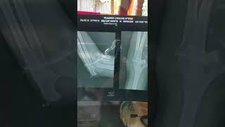 X-Ray