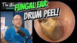 FUNGAL EAR DRUM PEEL! 382 #ear #earwax #earwaxremoval #satisfying #foryou #fyp #foryourpage