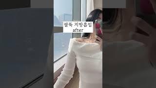 팔뚝지방흡입 | 팔뚝 3배 얇아진 후기 | 지방흡입 후기 | 지흡 비포 에프터 | 지흡 브이로그 | 다이어트 방법 #지방흡입 #팔뚝지방흡입 #지흡