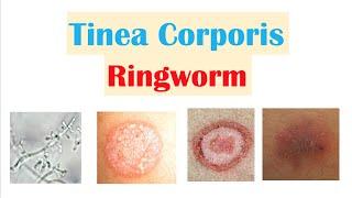 Ringworm (Tinea Corporis) | Causes, Risk Factors, Signs & Symptoms, Diagnosis and Treatment