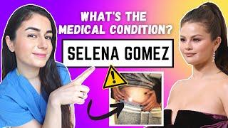 Lupus - Selena Gomez | Dr Ezgi Ozcan