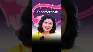 Endometriosis को कंट्रोल करने के Natural Tips और Fertility Diet! #shorts #prernasfertilitycare