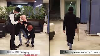 Change of Parkinson Patient Sanaa Aljaghali with DBS Treatment | Doç. Dr. Ali ZIRH