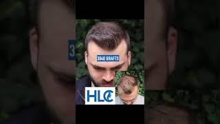 HLC Beratungen (Live Consultations): Haartransplantation Türkei (Hair Transplant Turkey) Frankfurt