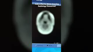 All Sequences In A 3T Brain MRI Scan #imaging #radiology #technology