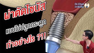 ฝังรากฟันเทียมในไซนัส แบบไม่ปลูกกระดูก ทำอย่างไร?!! | คลายปัญหารากฟันเทียมกับหมอโชค