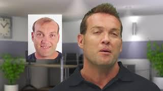 Jacques Kallis' hair replacement procedure by Advanced Hair Studio