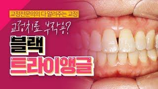 교정치료 부작용? 블랙트라이앵글 black triangle [이종국 원장의 다 알려주는 교정]