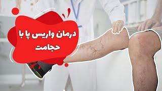 درمان واریس پا با حجامت