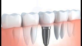 Implant treatment procedure