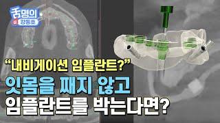 잇몸을 덜 째고 임플란트를 할 수 있다면? 내비게이션 임플란트의 활용법은?