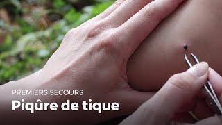 Premiers secours : Piqure de tique | Secourisme