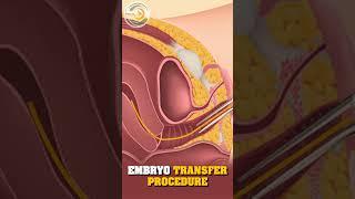 Embryo Transfer Procedure | Best Gynecology Doctor in Kanpur