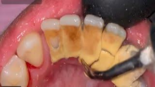 Teeth scaling calculus removal