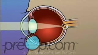 LASIK Laser Eye Surgery • Patient Education