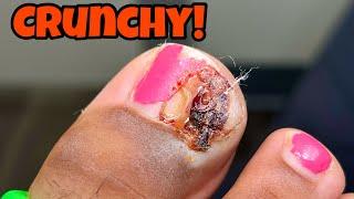 INFECTED INGROWN TOENAIL EXTRACTION