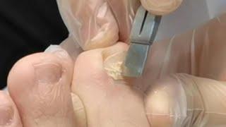甲沟炎修脚，脚趾甲千万别修太短【修脚小哥–阿伟】