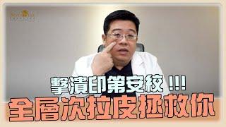 破解 拉皮話術! 完美擊潰 印第安紋，只靠全層次結構式 拉皮 可改善嗎?