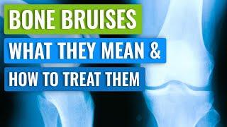 Bone Bruising in the Knee - Causes, Symptoms, and Treatment