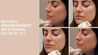 Natural Enhancements with Dermal Filler at V.I.