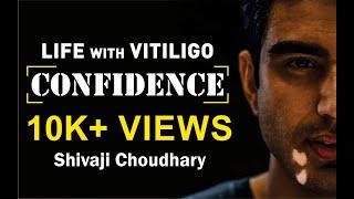 Vitiligo - How to live with Vitiligo? Confidence with Shivaji Choudhary - Episode 1(Heart to Heart)