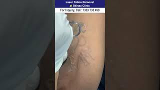 Laser Tattoo Removal Treatment at Skinaa Clinic