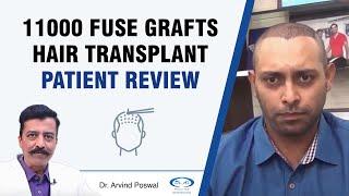 Hair Transplant - International Patient Review | 11,000 Grafts | Dr A's Clinic