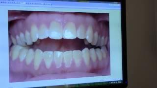 Orthodontist NYC Fixes Open Bite with non-surgical Alf Appliance & Clear Braces