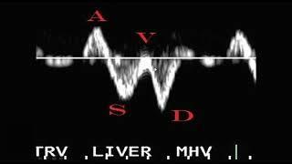 Traces   8   Hepatic Venous Flow