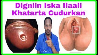 Cudurka Isfiritada/Warabowga(Syphilis)Waxa Sababa Calamadaha Lagu Garto & Sameyntisa Heerka 1 & 2 Ad