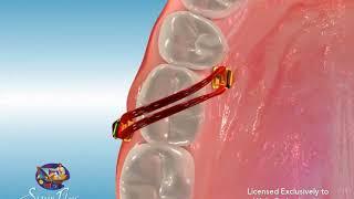 Tads Molar Intrusion