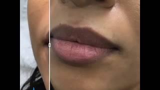 Lip fillers at Sky Clinic Birmingham