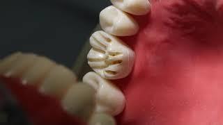 Full Zirconia Crown Prep #3 (rounded shoulder) - Dr. Mark R. Taylor