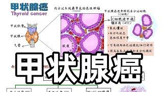 医学手绘 | 甲状腺癌  Medical hand drawing | Thyroid cancer