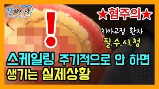 4-9.⭐실제상황⭐이렇게 되도 스케일링 치석제거 안하실 건가요 치아교정 환자 필수시청! 혐주의