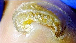 Ingrown Toenails That Have Grown Curly For Many Years, Perfectly Cured【Xue Yidao】