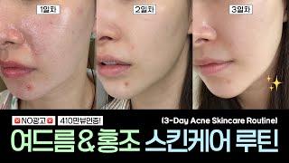 4.1M Views Verified‼️ Try this for 3 days, night skincare to calm acne & redness | Arang