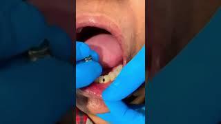 LIVE: Artificial Teeth Replacement | Dental Care | Eledent Dental Hospitals | #shorts #dentalcare